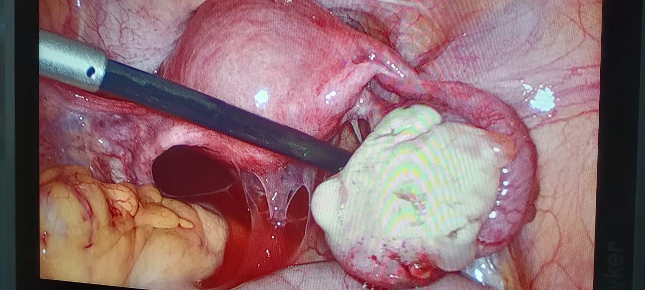 Laparoscopy procedure
