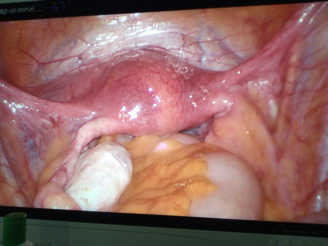 Laparoscopic surgery