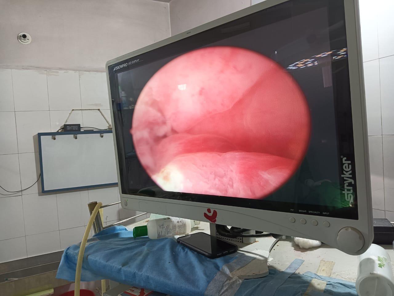 Hysteroscopy